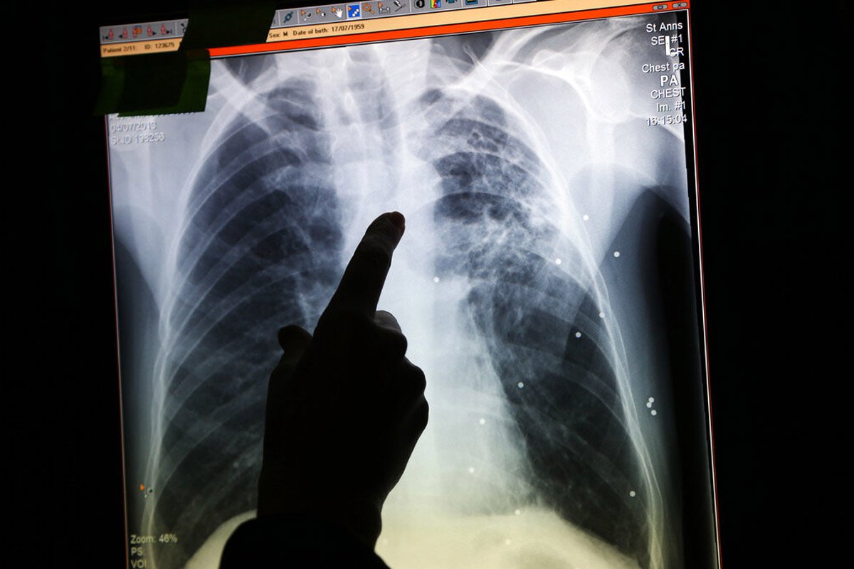 Autoridades sanitarias investigan contagios de tuberculosis en un centro de detención de inmigrantes